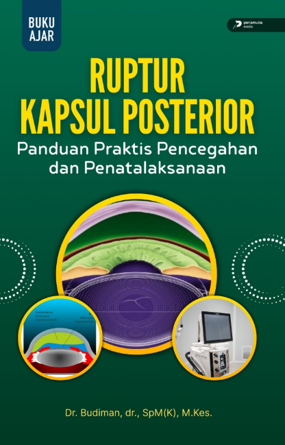 RUPTUR KAPSUL POSTERIOR PANDUAN PRAKTIS PENCEGAHAN DAN PENATALAKSANAAN