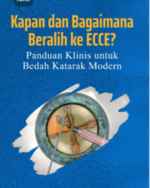 KAPAN DAN BAGAIMANA BERALIH KE ECCE? PANDUAN KLINIS UNTUK BEDAH KATARAK MODERN